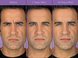 Botox Before & After Photo Man