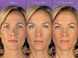 Botox Before & After Photo Woman