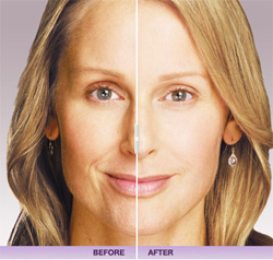 JUV�DERM� Gel Filler