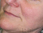 After Rosacea Treament with IPL