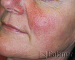 Before Rosacea Treament with IPL