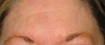 forehead laser treatments after