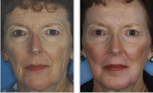 Skin Resurfacing Treatment
